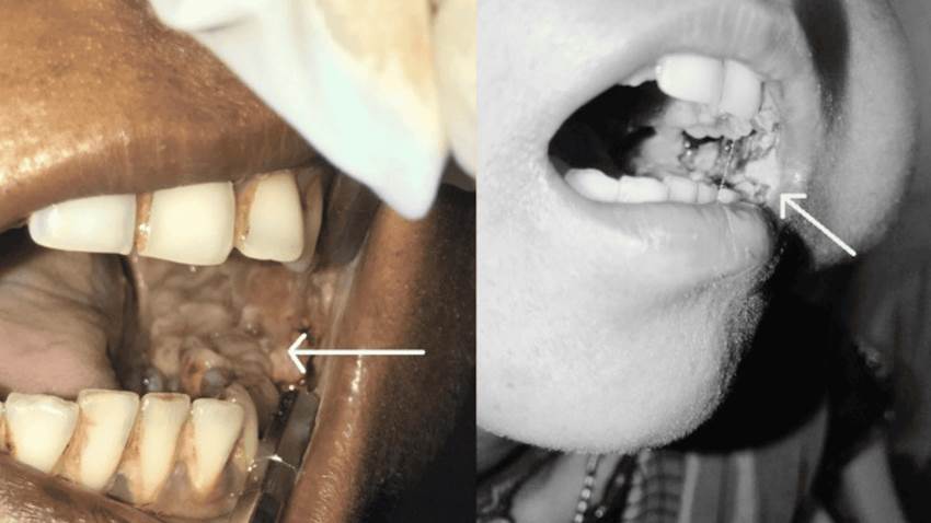 Raro caso de agresivo carcinoma de células escamosas en mucosa oral por tabaco de mascar