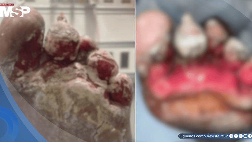 Lesión en el pie evoluciona a infección por la bacteria Pseudomonas aeruginosa resistente a tratamiento