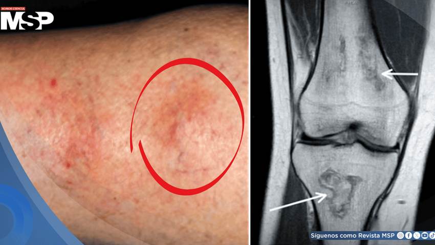Nudos en extremidad revelan lupus y síndrome antifosfolípido en mujer con inflamación articular y úlceras
