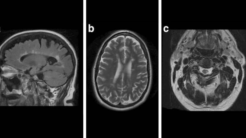 Convulsiones medulares causan dolor facial atípico en paciente con esclerosis múltiple