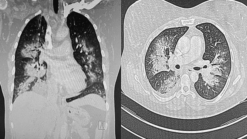 Mujer contrae infección por Legionella en casa de alquiler y es el primer caso descrito de su tipo