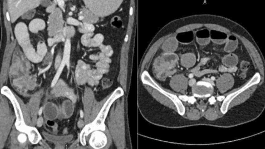 Paciente con carcinoma medular de colon presenta invasión linfovascular, necrosis y afectación ganglionar