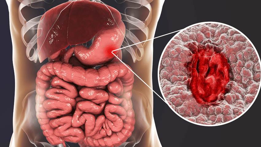 Eficacia del tacrolimús tópico en colitis ulcerosa distal alcanza remisión en un 47% de pacientes