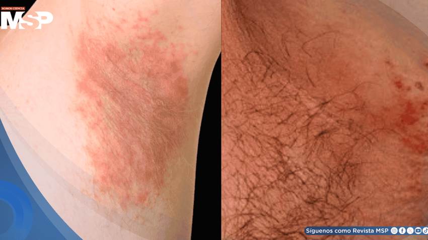 Hombre con obesidad presenta alergia a químico de ropa deportiva con erupción y prueba de parche positiva