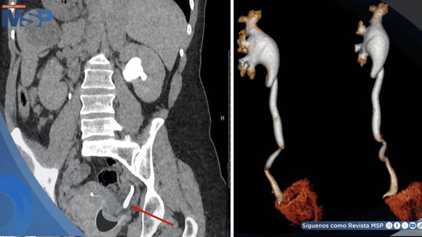 Dolor abdominal y hematuria revelan rara obstrucción ureteral causada por copa menstrual mal posicionada