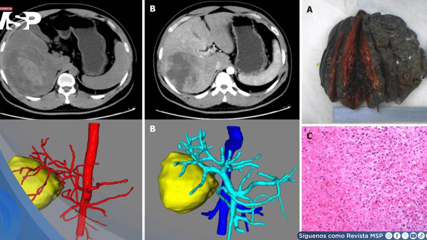 Infarto hepático en joven con dolor abdominal y fiebre simulaba tumor hemorrágico