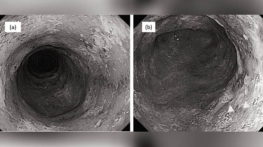 Manejo exitoso de colitis ulcerosa con vedolizumab en presencia de neumonía e infecciones oportunistas
