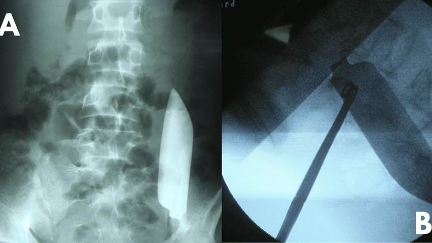 Extracción exitosa de hoja de cuchillo retenida en cavidad abdominal tras lesión en hipocondrio derecho