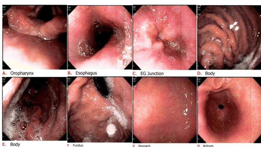 ¿Qué es la gastritis nerviosa y por qué es una respuesta del sistema digestivo al estrés y la ansiedad?