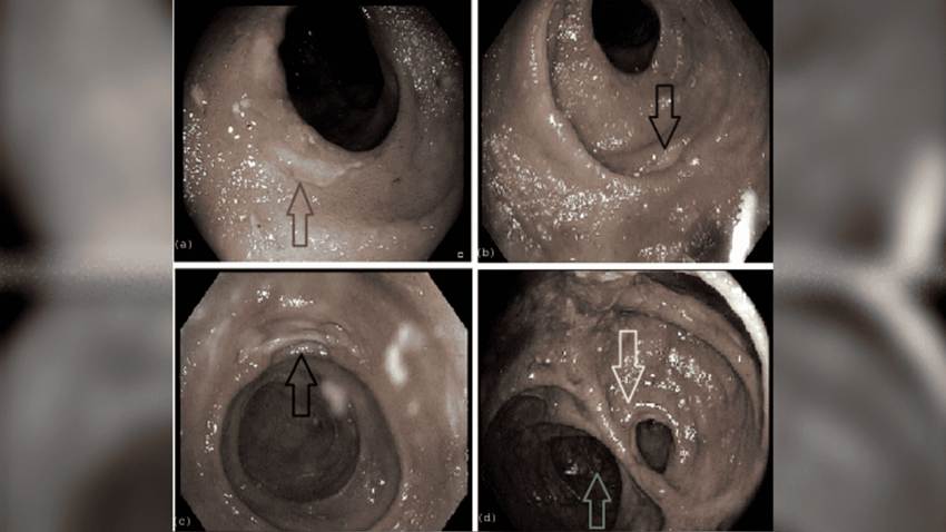 Complicaciones farmacológicas: Hombre de 68 años desarrolla Colitis inducida por Micofenolato