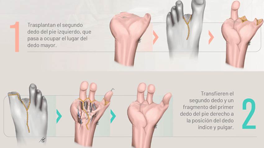 Especialistas reconstruyen mano de joven tras accidente utilizando los dedos de sus pies