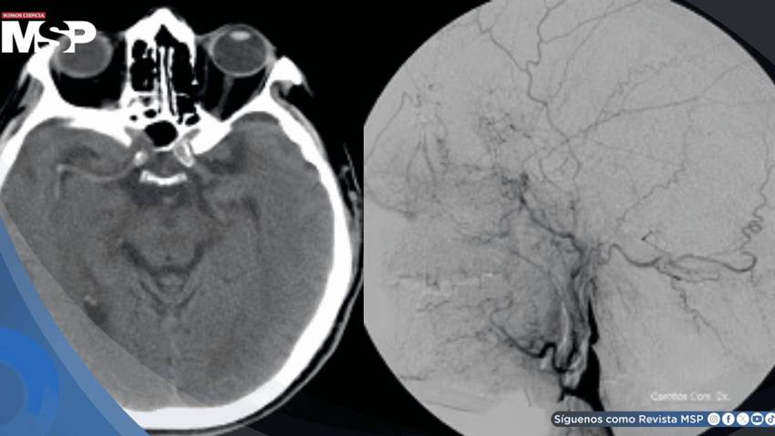 Tos violenta provocó la rotura de una arteria en el cuello y causó derrame cerebral en hombre de 57 años