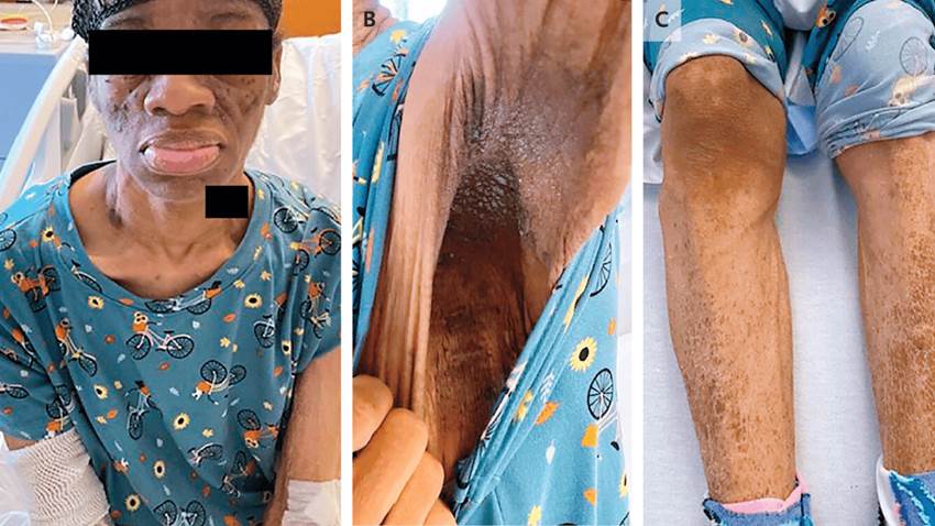 Paciente con diabetes tipo 2 presentó hiperglucemia pese a recibir más de 2000 unidades de insulina diarias