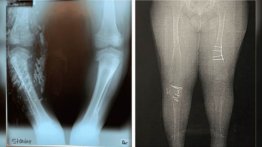 Polidactilia, obesidad y retinosis pigmentaria: Criterios diagnósticos de Síndrome Bardet-Biedl