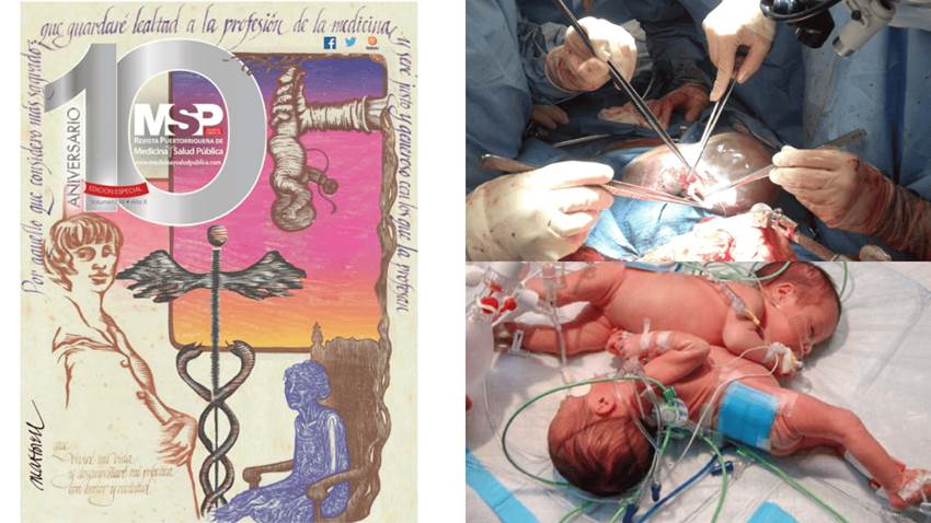 Primer trasplante de hígado y separación de siamesas en Puerto Rico: Los hitos de la Revista MSP impresa