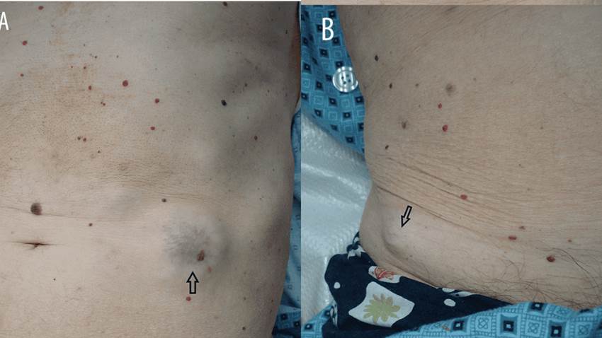 Nódulos en la piel conllevan a detección de cáncer de pulmón en paciente con tabaquismo