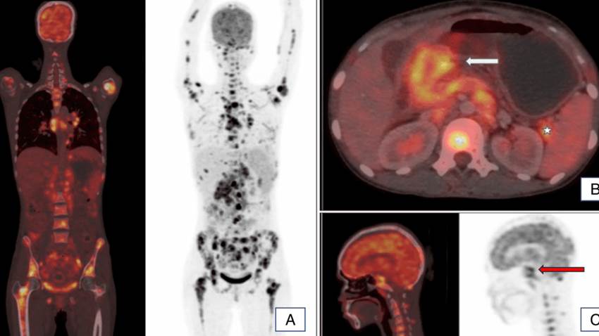 Cáncer gástrico hace metástasis en base del cráneo y produce tumor de Krukenberg en embarazada