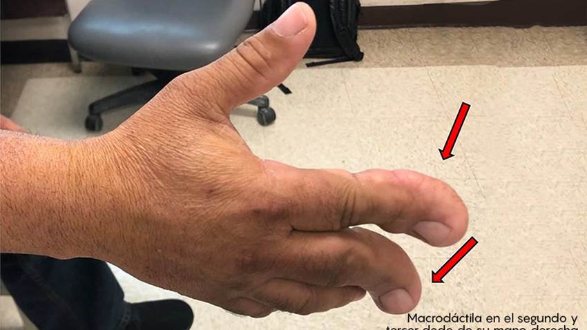 Salvan extremidad de paciente con tumor de la mano en Hospital Oncológico de Puerto Rico