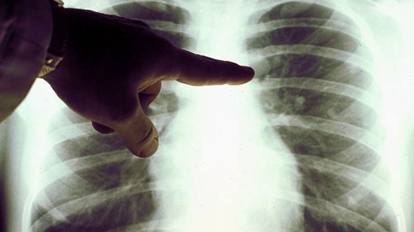 El extraño caso de la curación de un linfoma de Hodgkin por la COVID-19