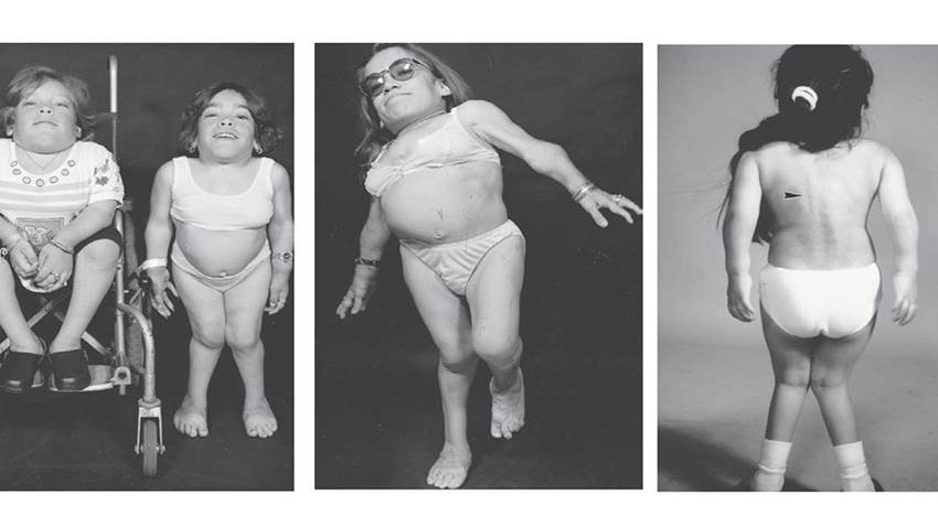 Promueven la conciencia del síndrome de morquio