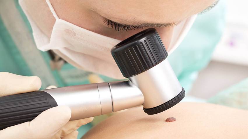 Lo que un lunar te puede contar sobre tu salud