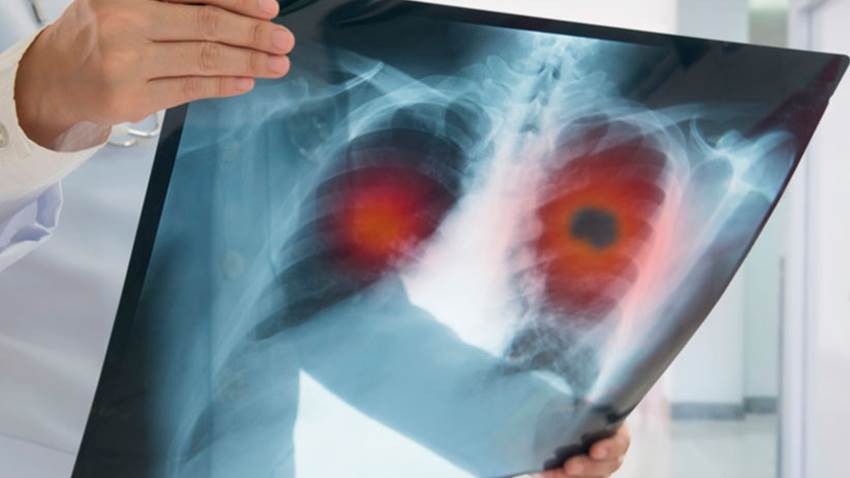 Avances médicos: Terapias biológicas dirigidas el cáncer del pulmón