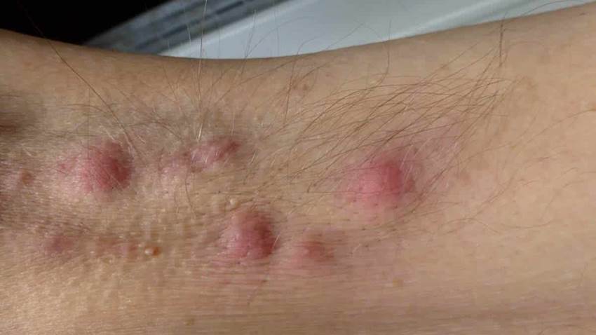 Científicos evalúan eficacia de anticuerpo monoclonal de psoriasis para Hidradenitis Supurativa