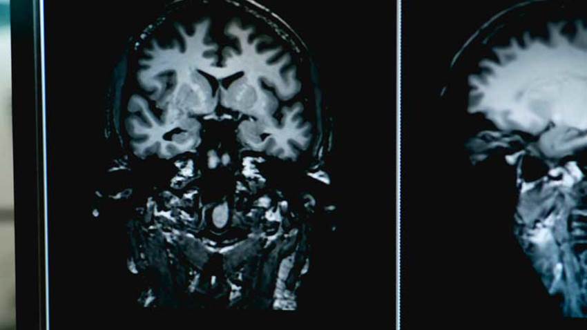 La deficiencia de ácido fólico podría estar relacionada con el alzhéimer