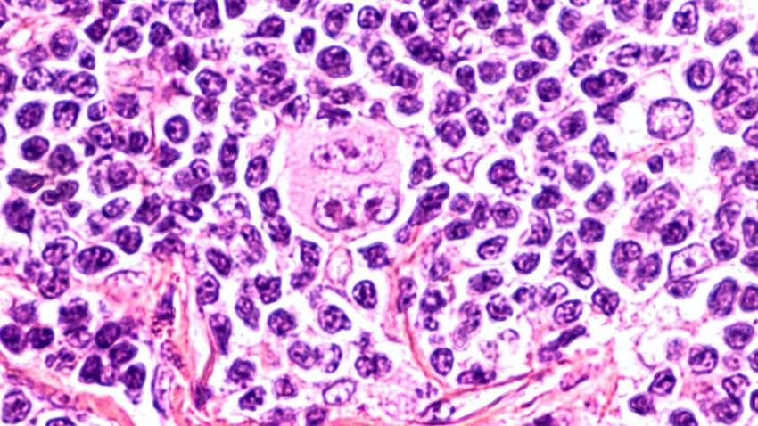 Mutación genética es clave en la aparición de linfomas y cáncer de pulmón, según estudio