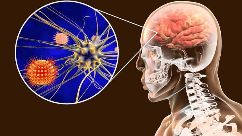 Tres pacientes fallecieron por brote de meningitis aséptica