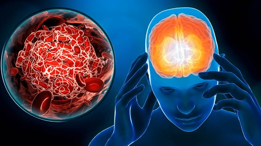 Migrañas, strokes y demencia son las afecciones neurológicas más comunes, según estudio