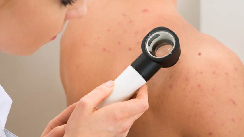 Hidradenitis supurativa: una enfermedad con mayor prevalencia en mujeres