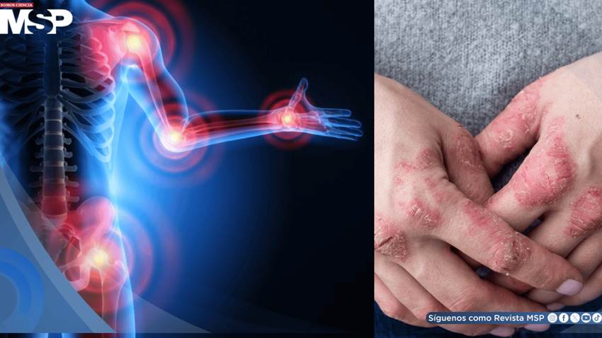 Artritis psoriásica después de los 60 años presenta más comorbilidades y menor acceso a biológicos