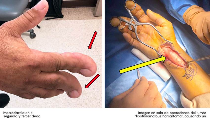 Reportan primer caso en paciente hispano de grave tumor en los nervios de la mano
