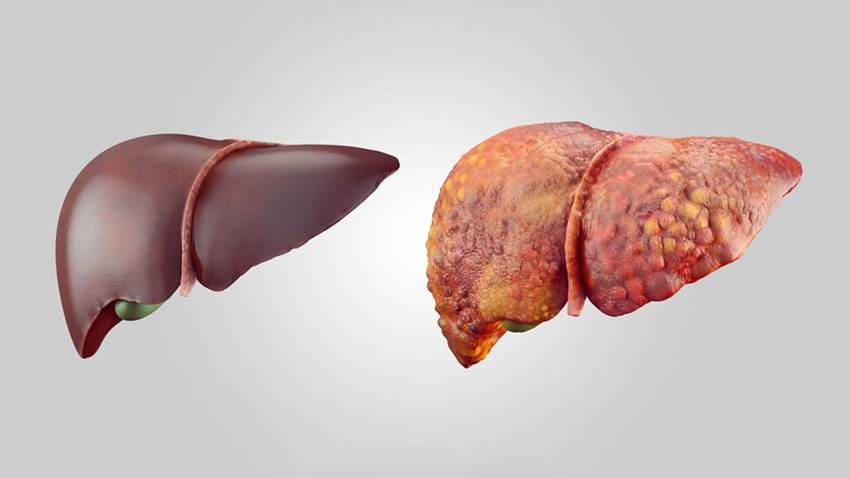 Importancia de la concienciación sobre el alcohol como agente carcinógeno