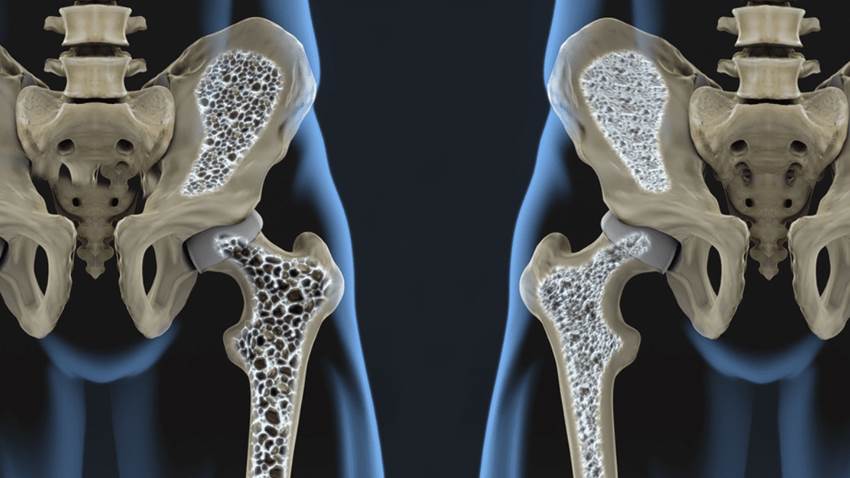 UCSF y la NASA adelantan investigación sobre osteoporosis y la absorciometría de rayos X de energía dual