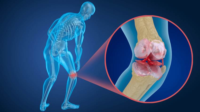 Hipertensión arterial podría aumentar envejecimiento óseo y riesgo de osteoporosis