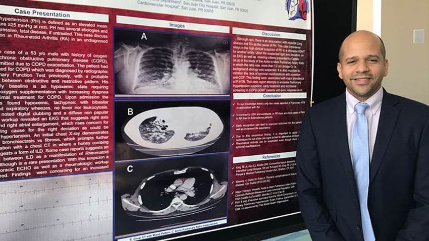 Síntomas en pulmón y no en articulaciones se presenta en paciente de artritis puertorriqueño