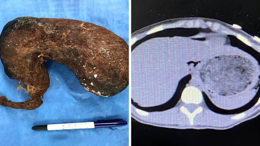 Descubren tumor de cabello humano en el abdomen de joven puertorriqueña