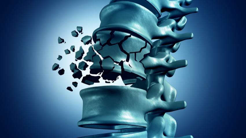 Caso clínico prueba que fármacos podrían retrasar la pérdida ósea en pacientes con Gaucher tipo I