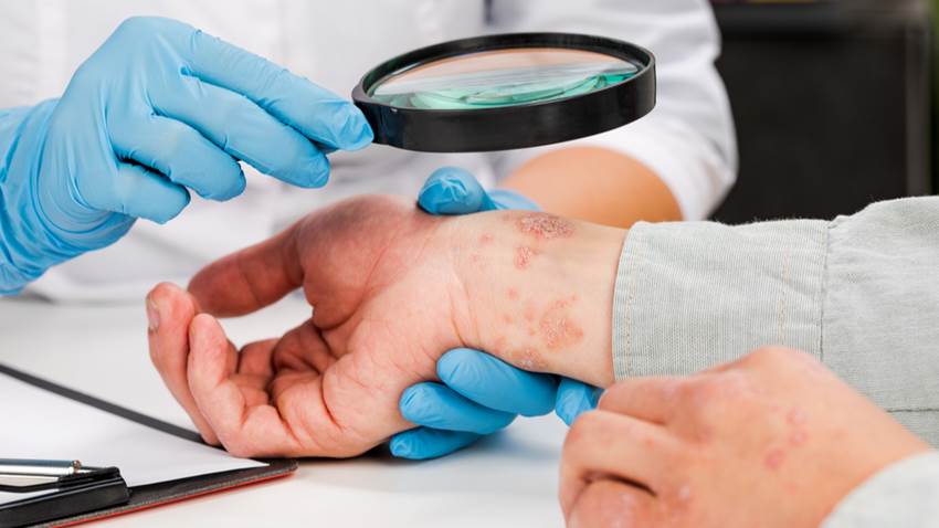 El rango de los signos cutáneos del COVID-19 está relacionado con la gravedad de la enfermedad