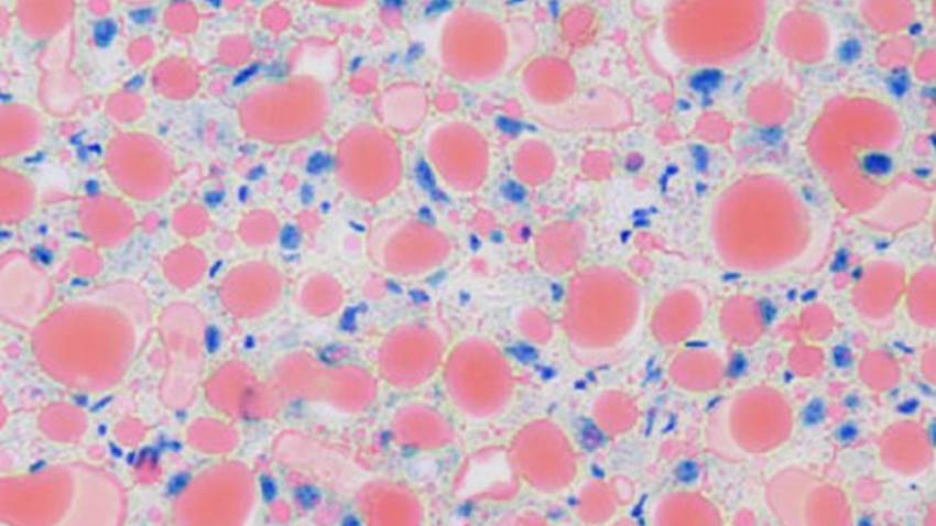 Descubren una proteína que protege contra el hígado graso