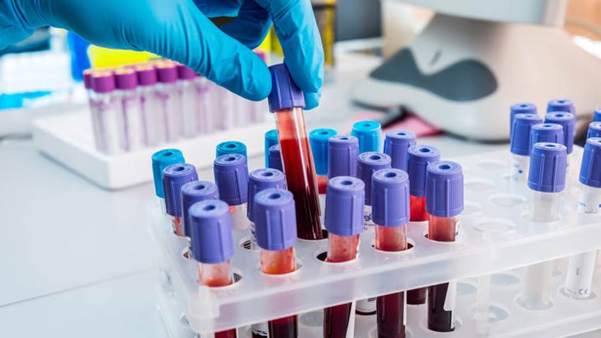 Detección temprana del alzhéimer sería posible a través de una prueba de sangre