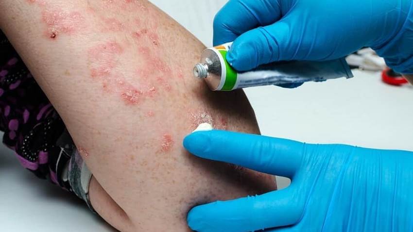 Tratamientos para la psoriasis guttata aguda: exclusión de los fármacos para la infección bacteriana