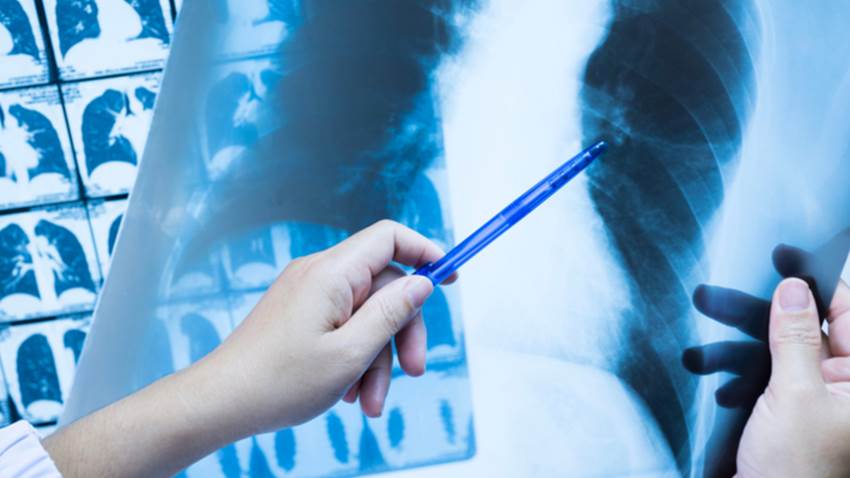 Prevalencia del cáncer de pulmón y múltiples causas