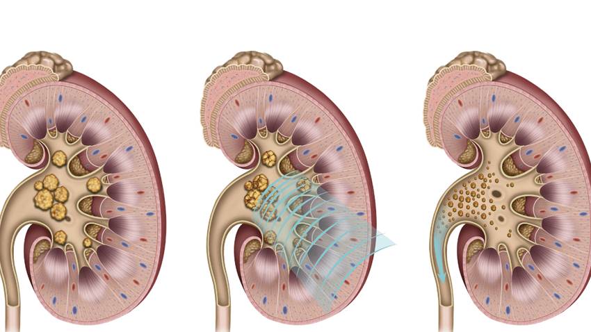 Terapias genéticas vs Terapias de bajo costo: Prometedor futuro en la prevención de cálculos renales