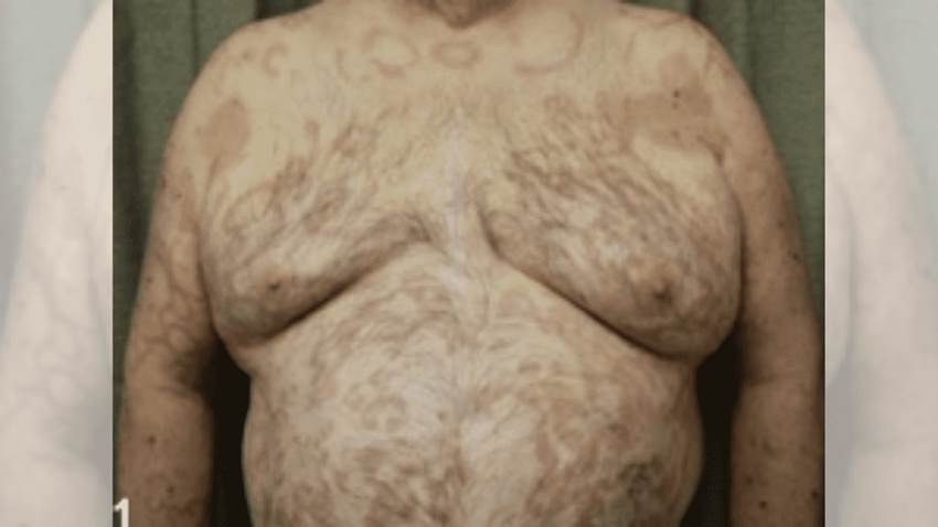 Paciente desarrolla erupción papuloescamosa generalizada tras diagnóstico de sífilis secundaria