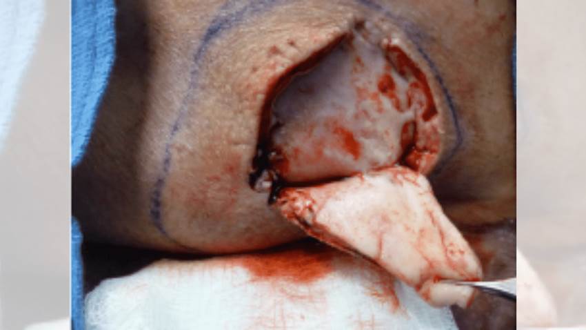 Reiteran el beneficio de la cirugía en pacientes con hidradenitis supurativa