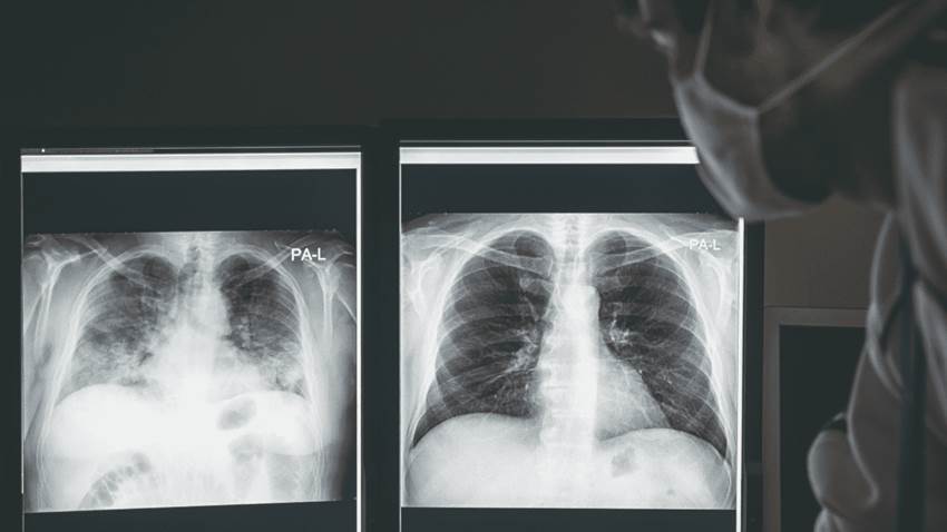 Jóvenes con obesidad presentarían exacerbación de síntomas respiratorios por COVID-19, según estudio