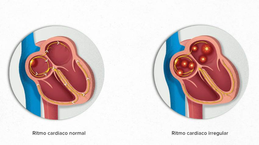 Aumento de actividad física se relaciona con menores probabilidades de padecer fibrilación auricular
